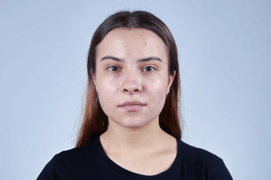 Skincare para Pele Oleosa